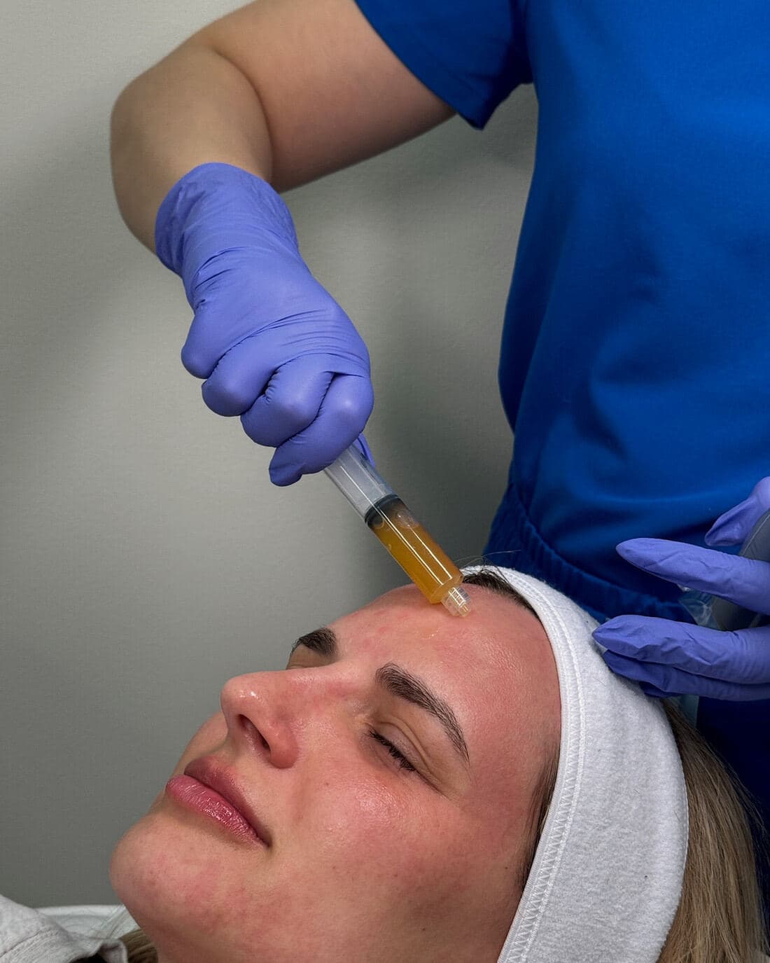 PRF platelet-rich fibrin skin therapy at The Beauty Spot Medspa.