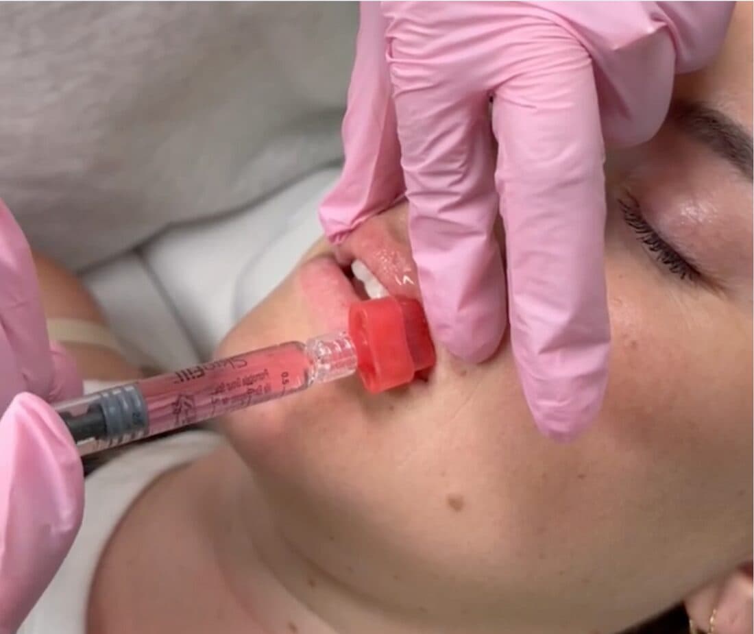 Skinfill Bacio collagen biostimulator at The Beauty Spot Medspa.