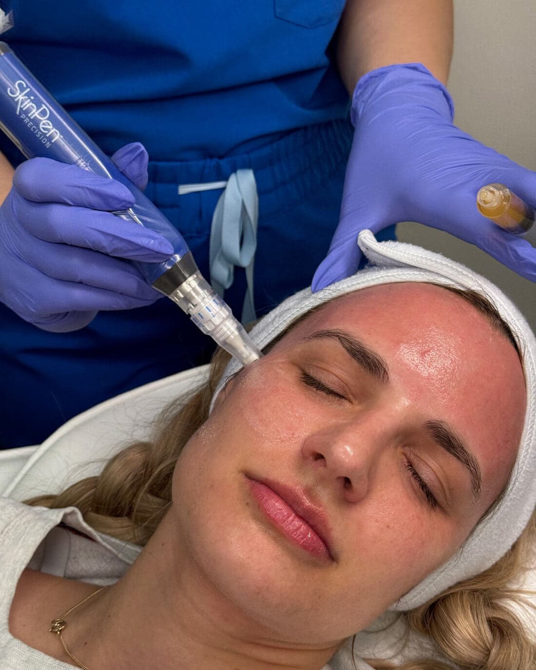 SkinPen microneedling at The Beauty Spot Medspa.