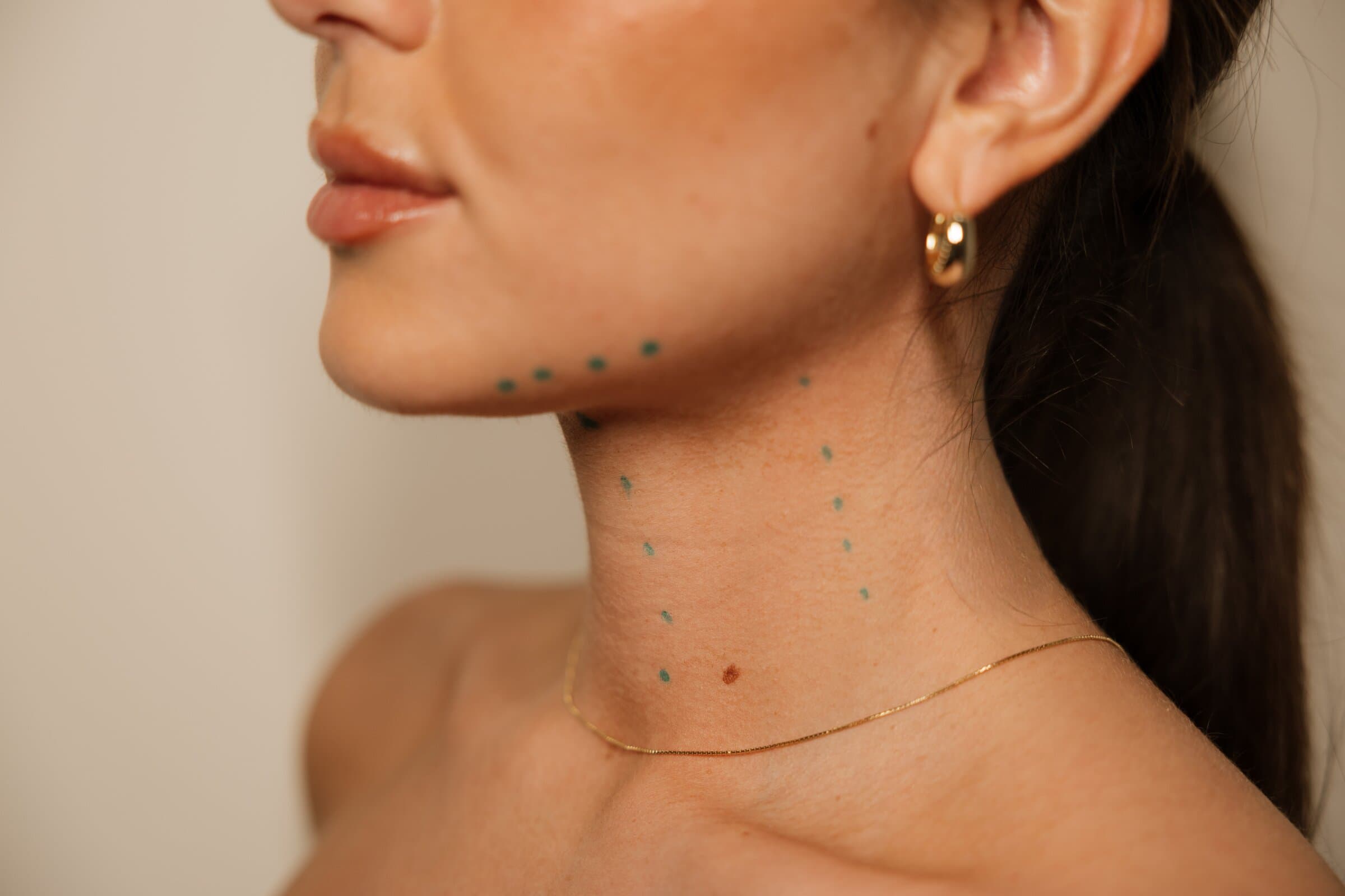 Profile of a patient's jawline and neck marked with green injection-mapping dots along the masseter and platysmal bands, the way a Botox dose is planned to each patient's anatomy at The Beauty Spot.