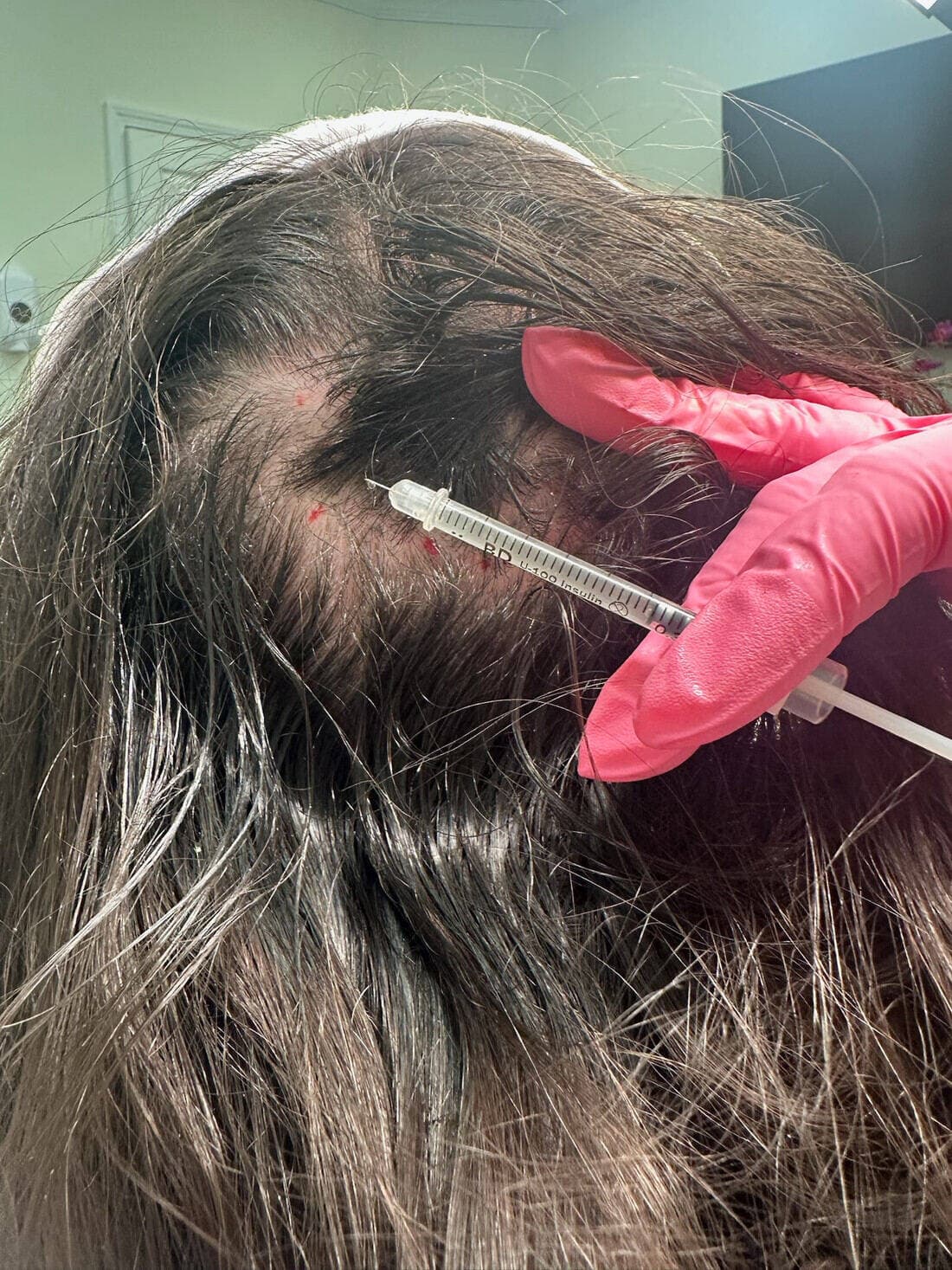 PRF hair restoration treatment at The Beauty Spot Medspa.