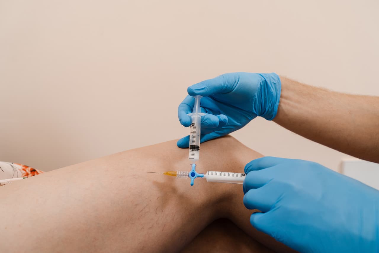 Sclerotherapy treatment for spider veins at The Beauty Spot Medspa.